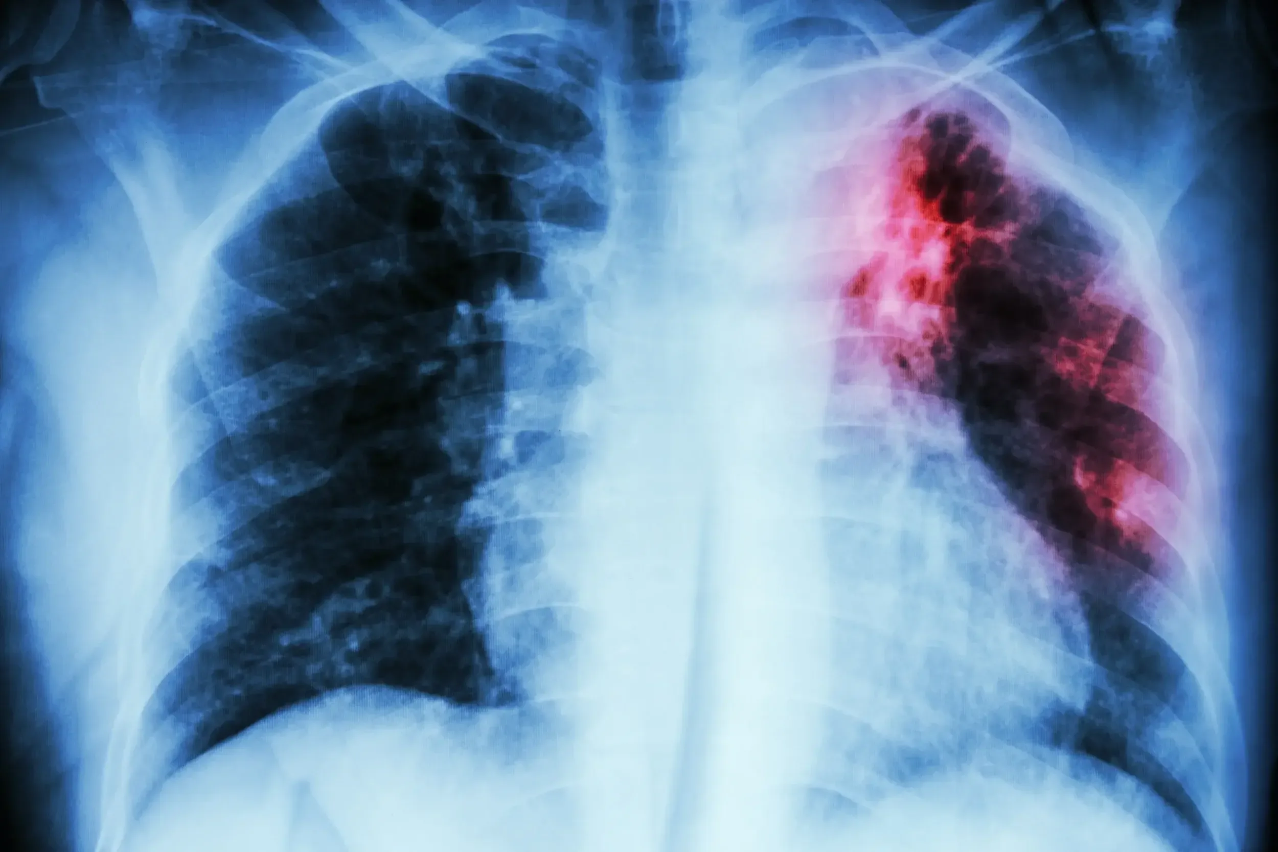 Tuberculosis lungs